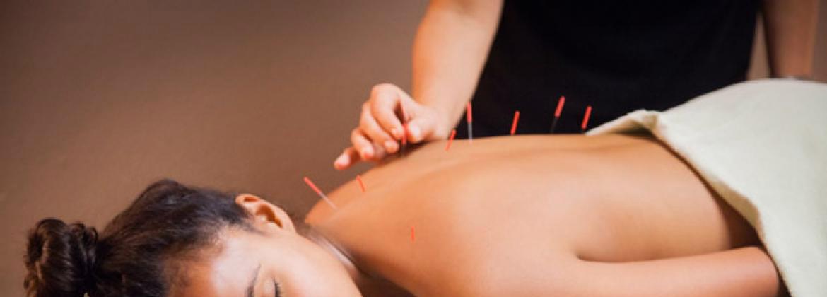 Acupuncture
