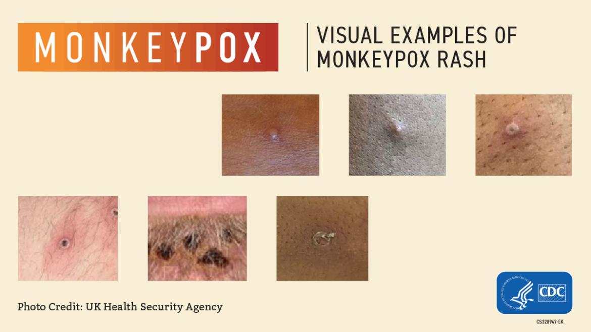 Monkeypox Visual Guide from CDC showing pox on skin