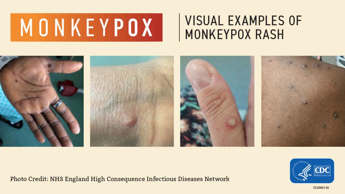 Monkeypox Visual Guide from CDC showing pox on skin